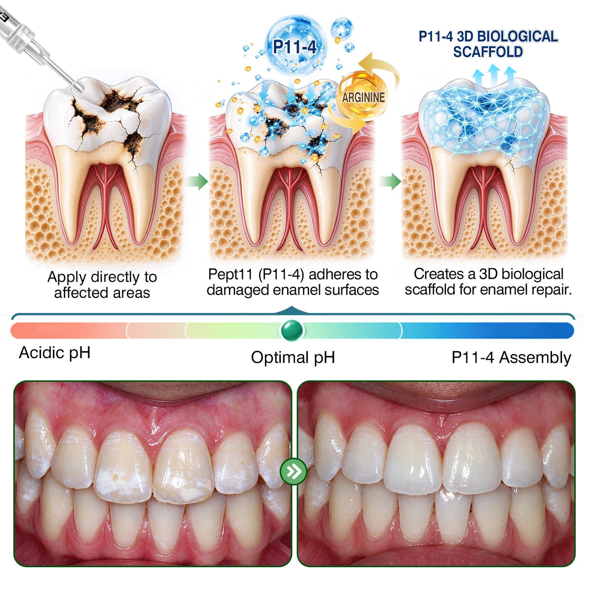 🇦🇺👨‍⚕️🦷✨Purelora® CavityReverse Pept11 MicroFill Gel