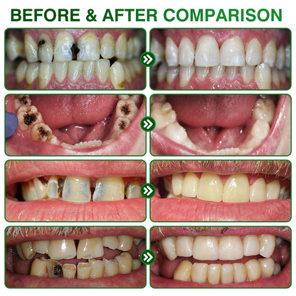 🇦🇺👨‍⚕️🦷✨Purelora® CavityReverse Pept11 MicroFill Gel