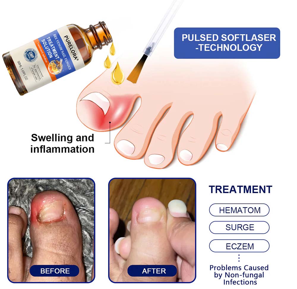 PURELORA® 👣Bee Venom Nail Fungus Treatment Solution👣
