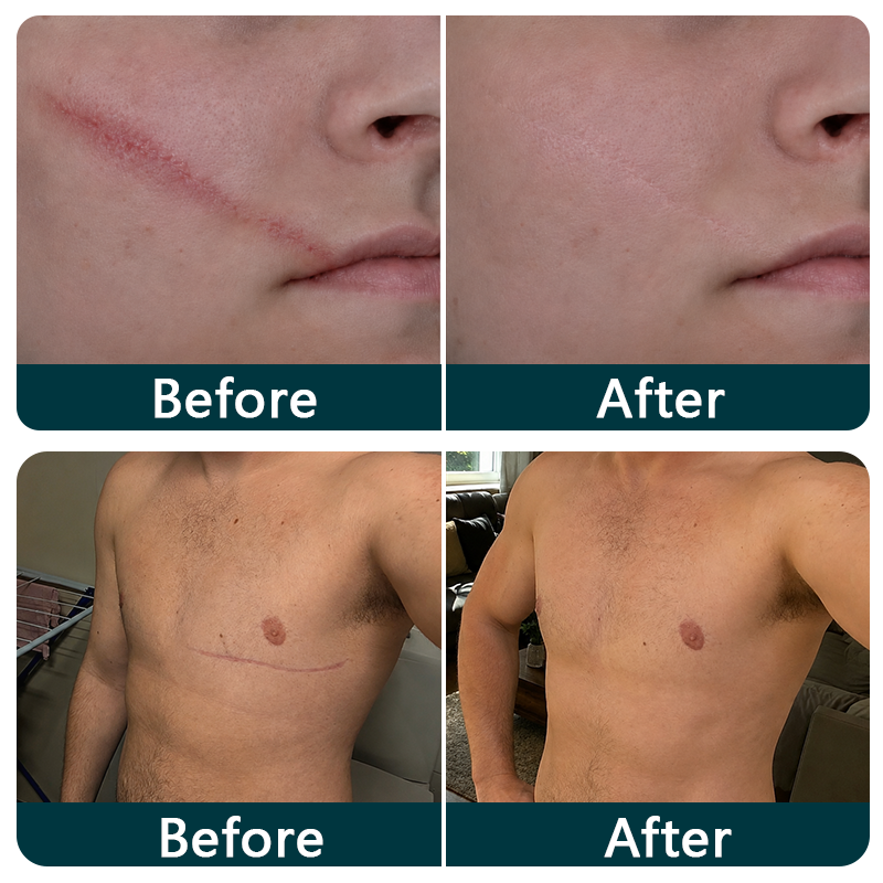 🇦🇺👩‍⚕️✨Purelora® SILICONE SCAR THERAPY ROLL Help Soften, Flatten & Improve the Appearance of Raised Scars