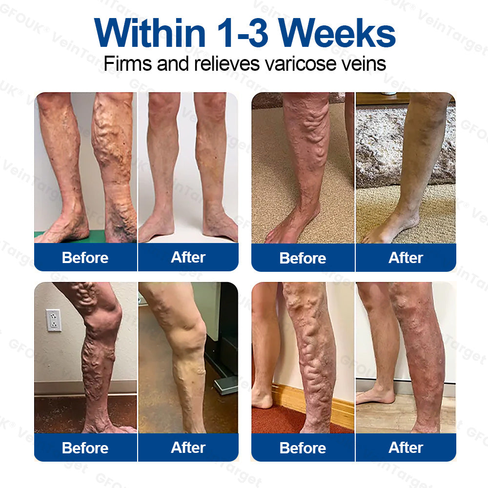 🇦🇺🦘👨‍⚕️✨ CURALONA® VeinTarget Microneedle Patch ⚡ Fast Relief, Long-Lasting Support