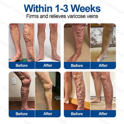 🇦🇺🦘👨‍⚕️✨ CURALONA® VeinTarget Microneedle Patch ⚡ Fast Relief, Long-Lasting Support