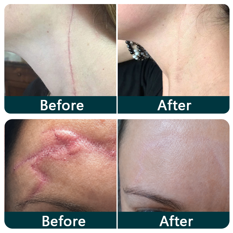 🇦🇺👩‍⚕️✨Purelora® SILICONE SCAR THERAPY ROLL Help Soften, Flatten & Improve the Appearance of Raised Scars