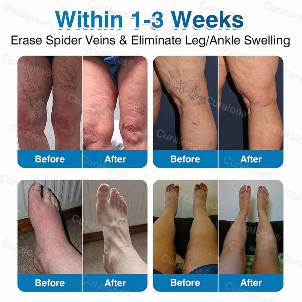 🇦🇺🏆✅️🏃 Curalona® VeinRepair Microneedle Patch Roll ⚡ Instant Relief, Long-Term Results