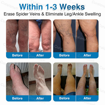 🇦🇺🏆✅️🏃 Curalona® VeinRepair Microneedle Patch Roll ⚡ Instant Relief, Long-Term Results