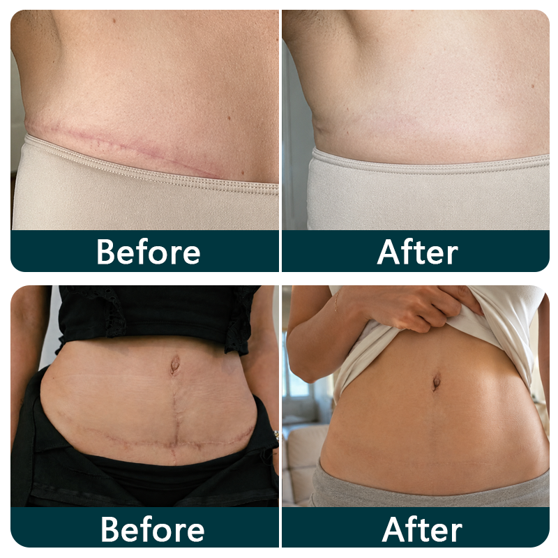 🇦🇺👩‍⚕️✨Purelora® SILICONE SCAR THERAPY ROLL Help Soften, Flatten & Improve the Appearance of Raised Scars