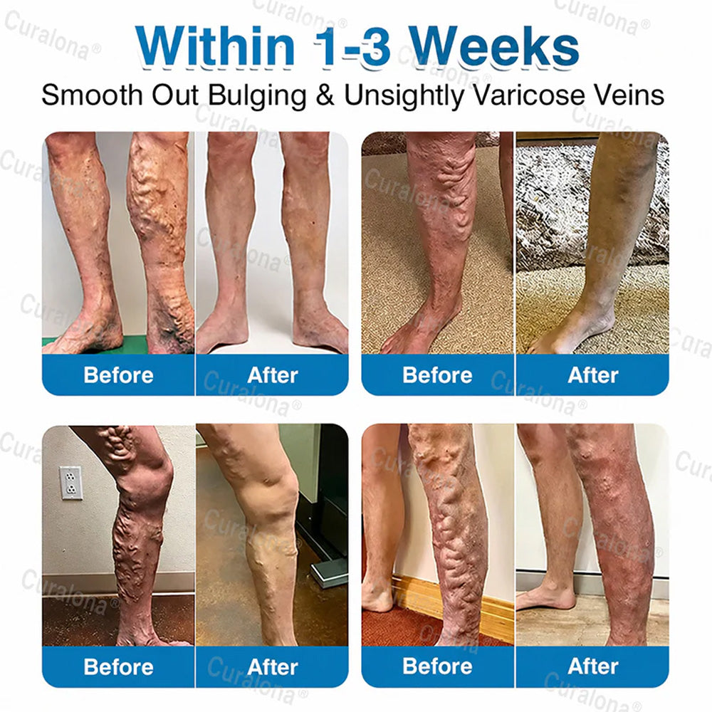🇦🇺🏆✅️🏃 Curalona® VeinRepair Microneedle Patch Roll ⚡ Instant Relief, Long-Term Results