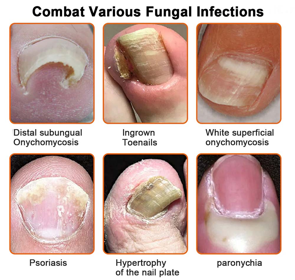 PURELORA® 👣Bee Venom Nail Fungus Treatment Solution👣