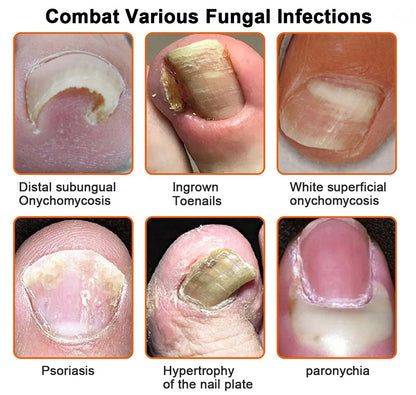 PURELORA® 👣Bee Venom Nail Fungus Treatment Solution👣