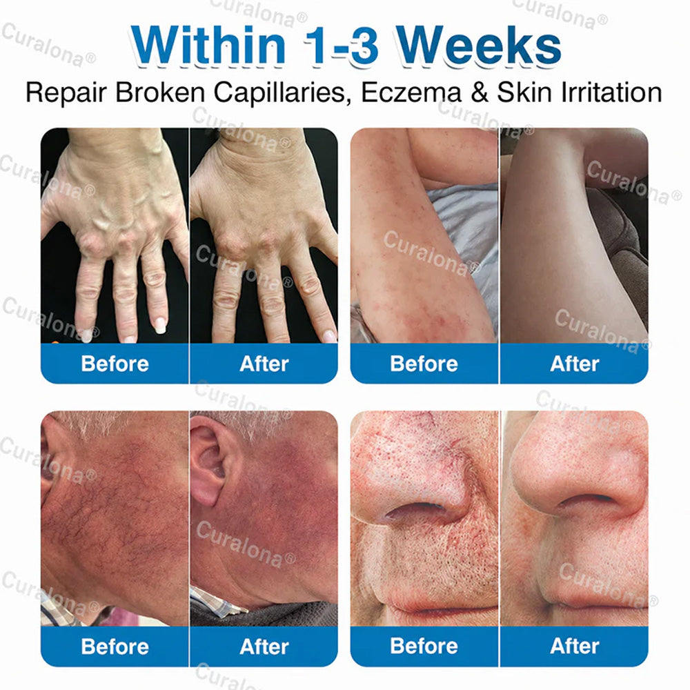 🇦🇺🏆✅️🏃 Curalona® VeinRepair Microneedle Patch Roll ⚡ Instant Relief, Long-Term Results